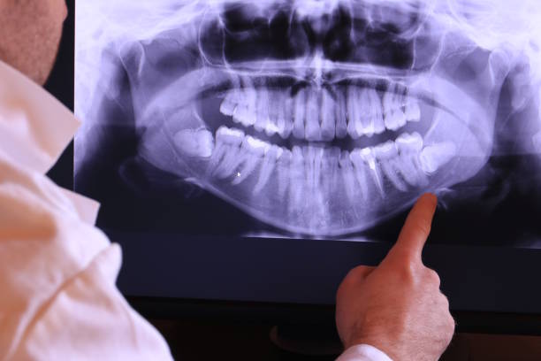 Best Emergency Wisdom Teeth Removal in Grayvle, IL