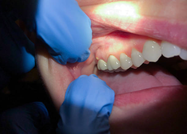 Best Emergency Treatment for Dental Infections or Abscesses in Grayvle, IL