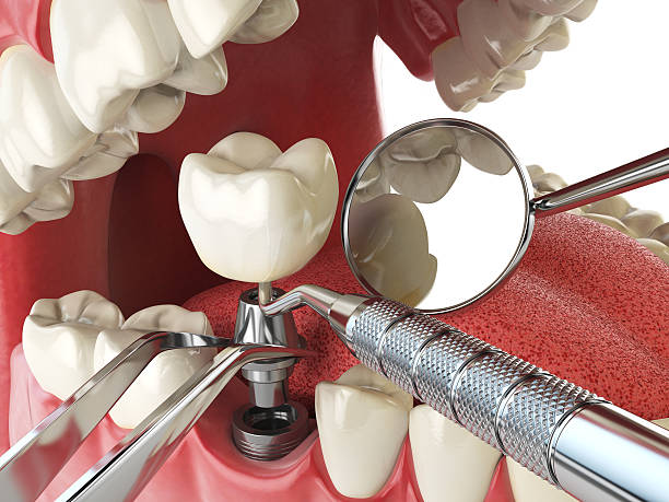 Best Emergency Tooth Extraction in Grayvle, IL